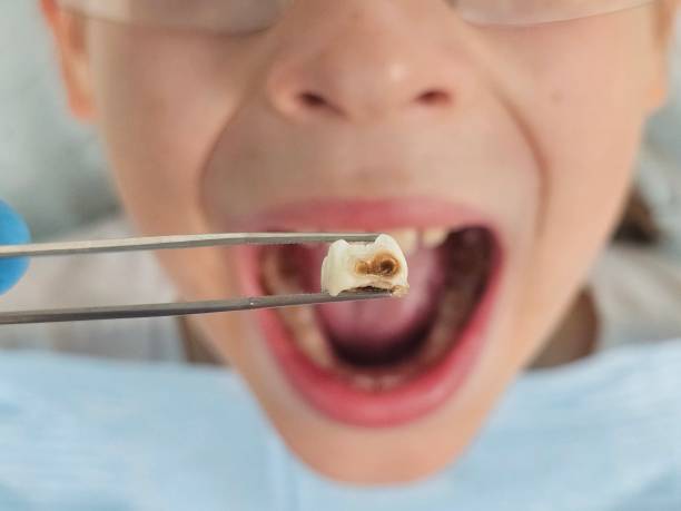 Best Emergency Root Canal Treatment in Stonewood, WV