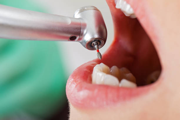 Best Emergency Root Canal Treatment in Stonewood, WV